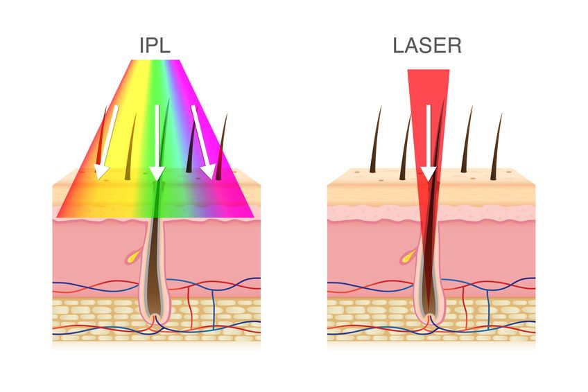 laser haarentfernung und ipl Frankfurt