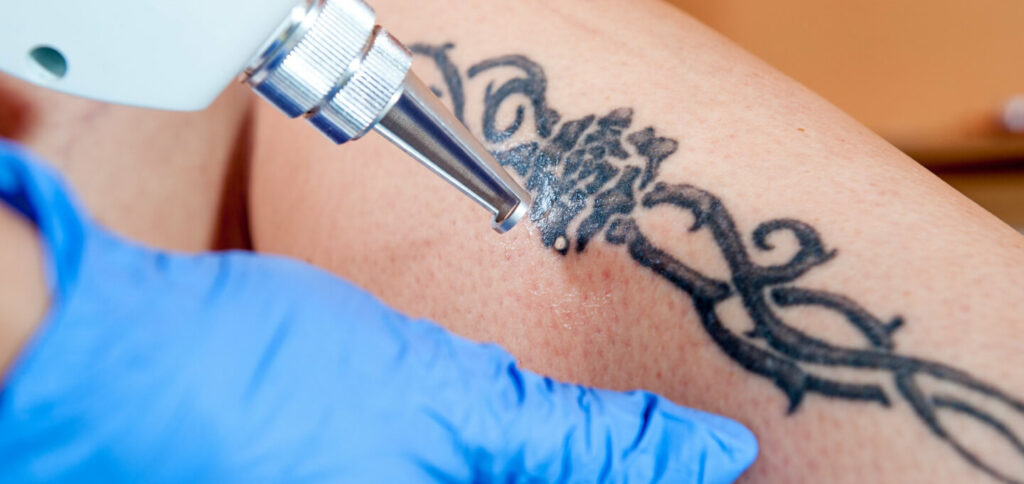 TATTOO REMOVAL | MSH