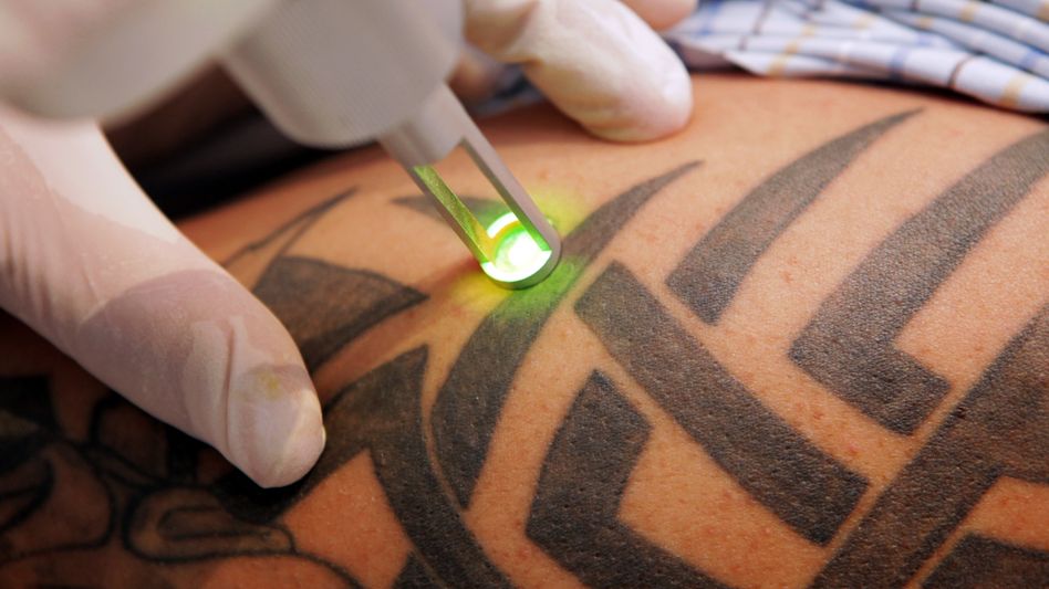 tattooentfernung laserzentrum frankfurt